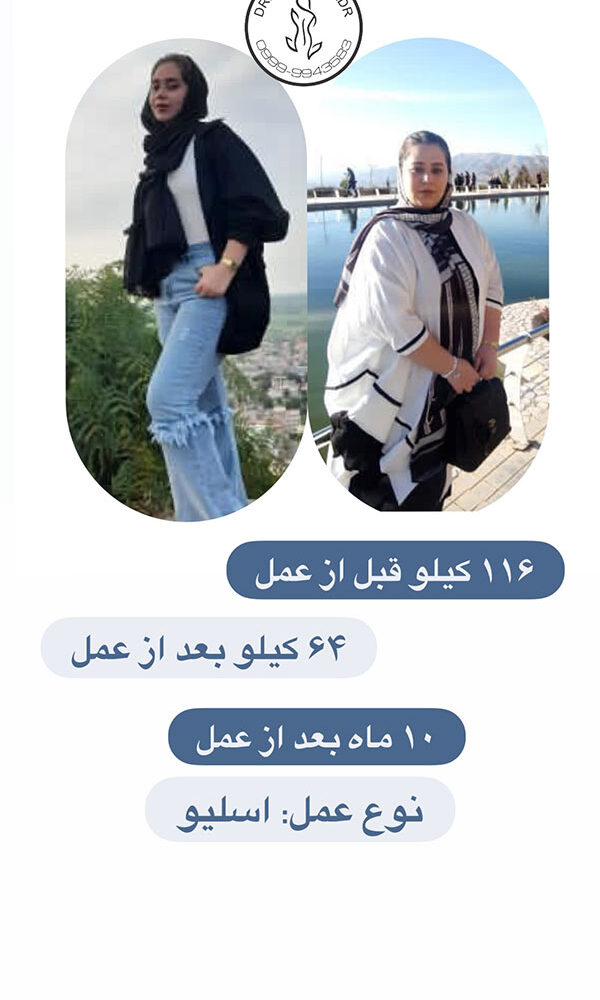 افرادی که عمل چاقی کرده اند قبل و بعد