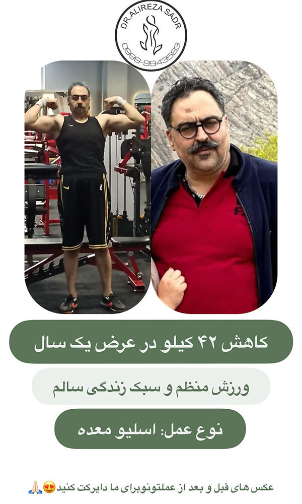 افرادی که عمل چاقی کرده اند قبل و بعد