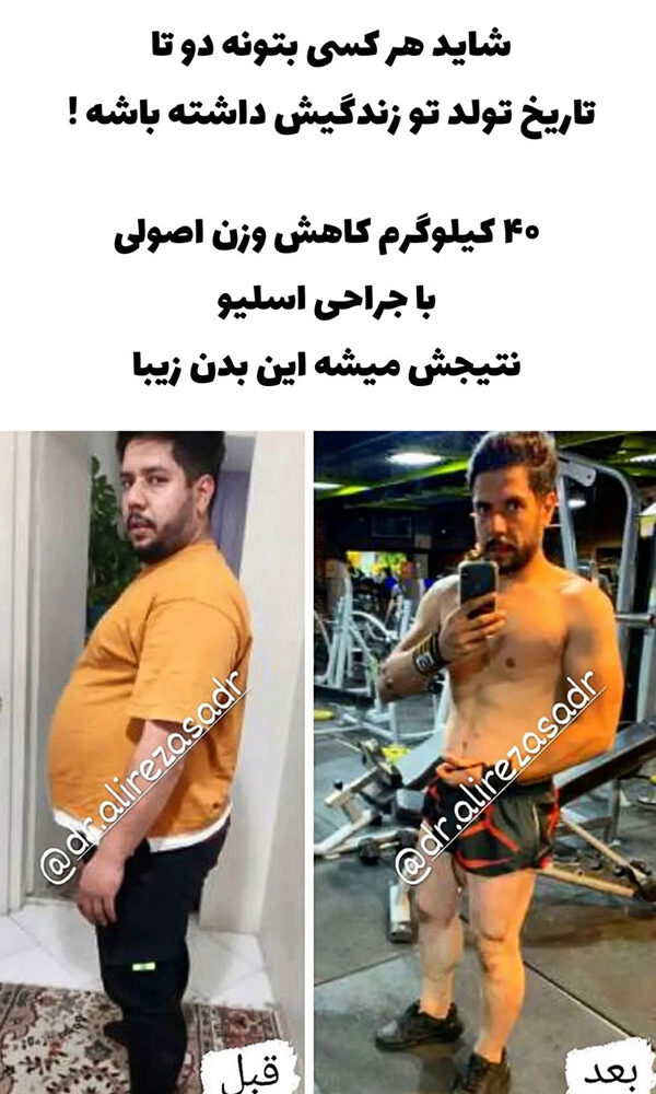 افرادی که عمل چاقی کرده اند قبل و بعد