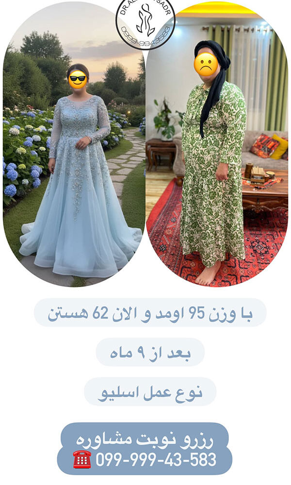 افرادی که عمل چاقی کرده اند قبل و بعد